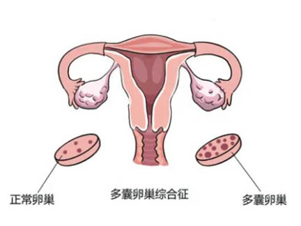 双侧多囊卵巢做试管婴儿的成功率高吗？