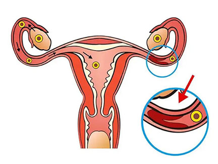 美国试管婴儿：引起女性输卵管堵塞的原因有哪些？